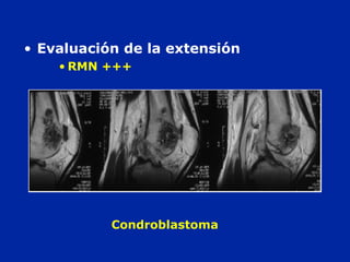 Condroblastoma
• Evaluación de la extensión
• RMN +++
 