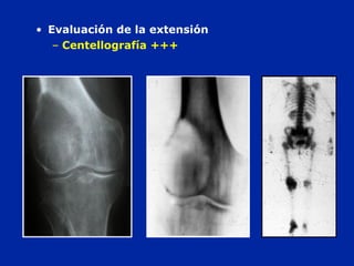 • Evaluación de la extensión
– Centellografía +++
 