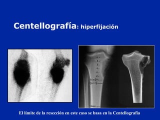 Centellografía: hiperfijación
El límite de la resección en este caso se basa en la Centellografía
 