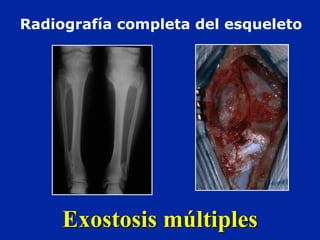 Exostosis múltiplesExostosis múltiples
Radiografía completa del esqueleto
 