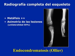 Endocondromatosis (Ollier)Endocondromatosis (Ollier)
• Metáfisis ++
• Asimetría de las lesiones
(unilateralidad 50%)
Radiografía completa del esqueleto
 