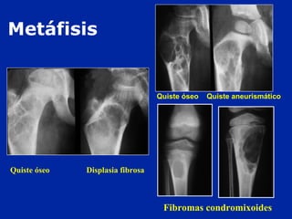 Fibromas condromixoides
Metáfisis
Quiste óseo Quiste aneurismático
Quiste óseo Displasia fibrosa
 