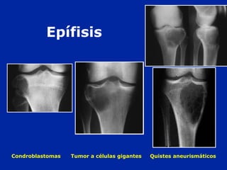 Condroblastomas Tumor a células gigantes Quistes aneurismáticos
Epífisis
 