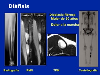 Radiografía RMN TDM Centellografía
Mujer de 30 años :
Dolor a la marcha
Displasia fibrosa
Diáfisis
 