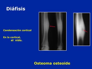Condensación cortical
En la cortical,
el nido.
Diáfisis
Osteoma osteoide
 