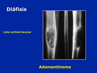 Lisis cortical lacunar
Diáfisis
Adamantinoma
 