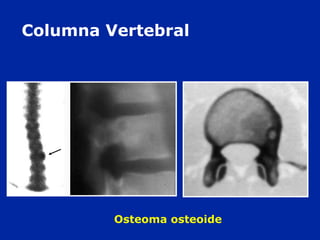 Columna Vertebral
Osteoma osteoide
 