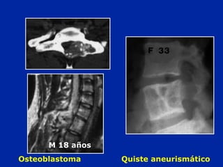 Osteoblastoma Quiste aneurismático
M 18 años
 