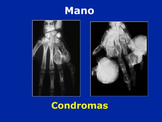Condromas
Mano
 