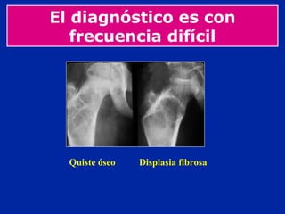 El diagnóstico es con
frecuencia difícil
Quiste óseo Displasia fibrosa
 