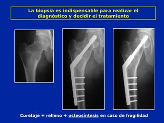 Curetaje + relleno + osteosíntesis en caso de fragilidad
La biopsia es indispensable para realizar el
diagnóstico y decidir el tratamiento
 
