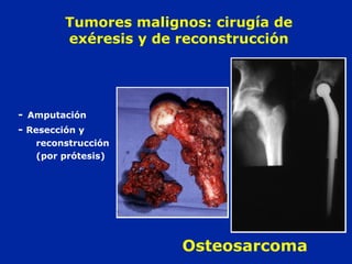- Amputación
- Resección y
reconstrucción
(por prótesis)
Osteosarcoma
Tumores malignos: cirugía de
exéresis y de reconstrucción
 