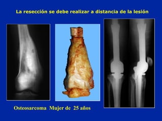 Osteosarcoma Mujer de 25 años
La resección se debe realizar a distancia de la lesión
 