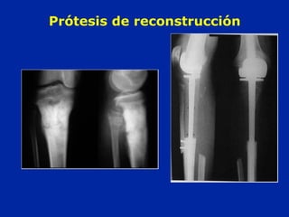 Prótesis de reconstrucción
 
