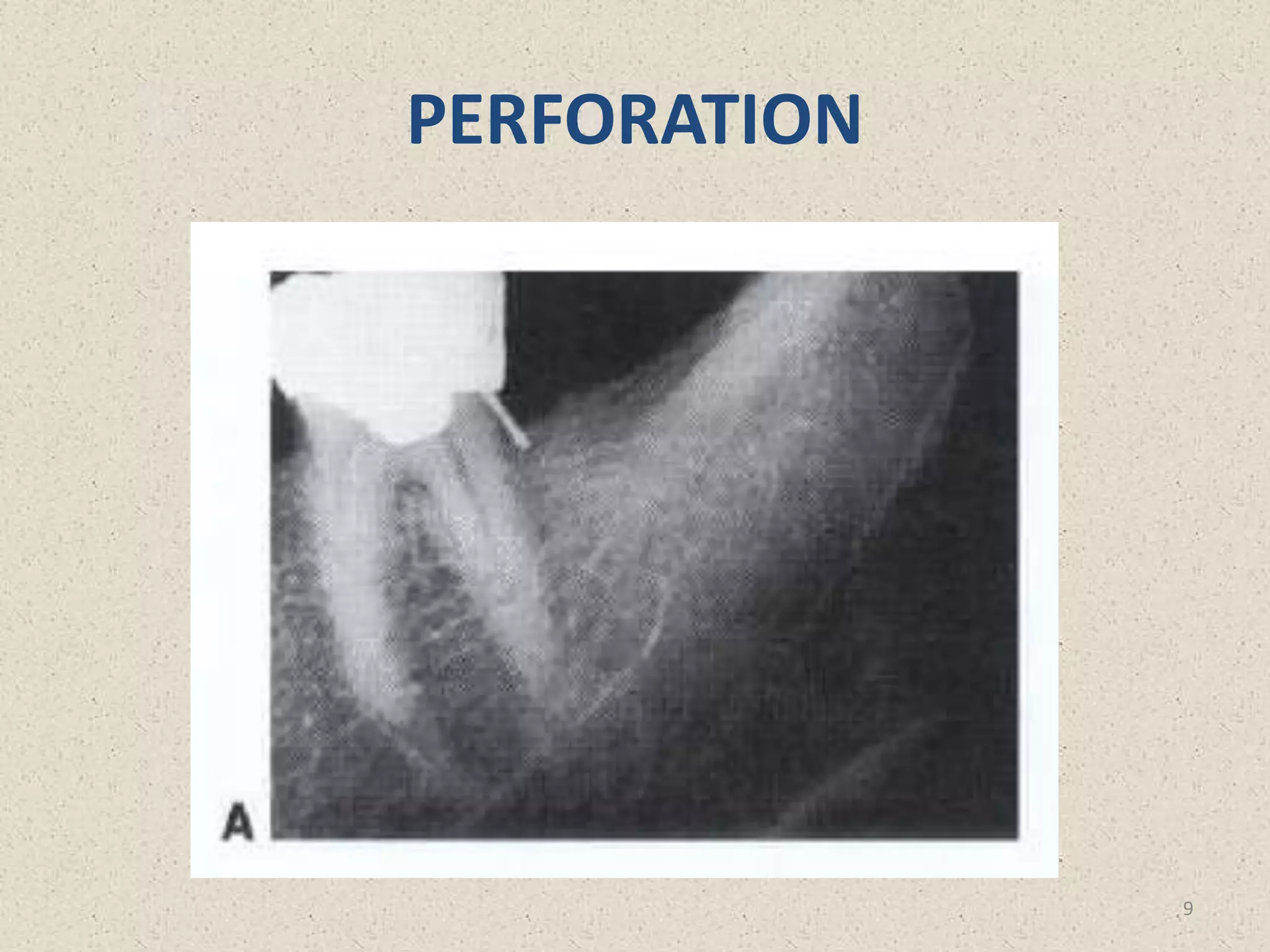 PERFORATION
9
 