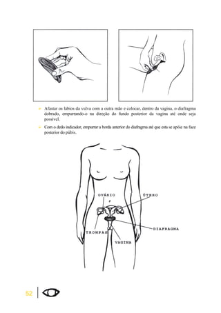 52 
¾Afastar os lábios da vulva com a outra mão e colocar, dentro da vagina, o diafragma 
dobrado, empurrando-o na direção do fundo posterior da vagina até onde seja 
possível. 
¾Com o dedo indicador, empurrar a borda anterior do diafragma até que esta se apóie na face 
posterior do púbis. 
 