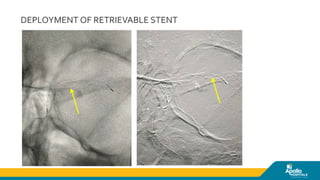 Intervention in acute ischemic stroke | PPTX