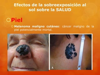 Efectos de la sobreexposición al
sol sobre la SALUD
Piel
 Melanoma maligno cutáneo: cáncer maligno de la
piel potencialmente mortal.
 