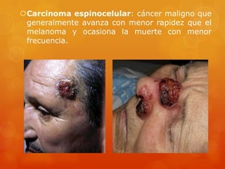 Carcinoma espinocelular: cáncer maligno que
generalmente avanza con menor rapidez que el
melanoma y ocasiona la muerte con menor
frecuencia.
 