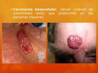 Carcinoma basocelular: cáncer cutáneo de
crecimiento lento que predomina en las
personas mayores.
 