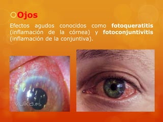 Ojos
Efectos agudos conocidos como fotoqueratitis
(inflamación de la córnea) y fotoconjuntivitis
(inflamación de la conjuntiva).
 