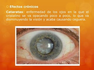  Efectos crónicos
Cataratas: enfermedad de los ojos en la que el
cristalino se va opacando poco a poco, lo que va
disminuyendo la visión y acaba causando ceguera.
 