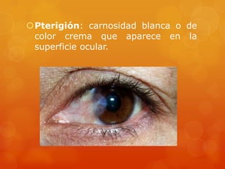 Pterigión: carnosidad blanca o de
color crema que aparece en la
superficie ocular.
 