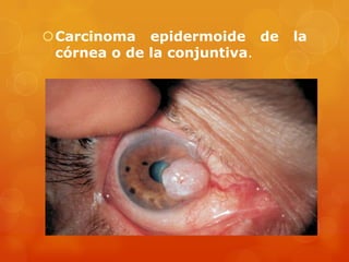 Carcinoma epidermoide de la
córnea o de la conjuntiva.
 