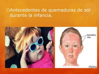 Antecedentes de quemaduras de sol
durante la infancia.
 