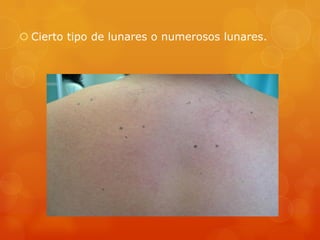  Cierto tipo de lunares o numerosos lunares.
 