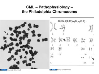 Cml Pathophysilogy 01.13.09: Chronic Myeloid Leukemia and other Myeloproliferative ...