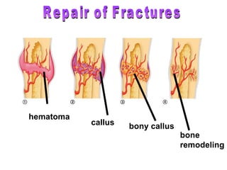 hematoma callus bony callus Repair of Fractures bone  remodeling 