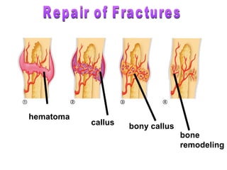 hematoma
callus bony callus
bone
remodeling
 