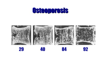 OsteoporosisOsteoporosis
29 40 84 92
 