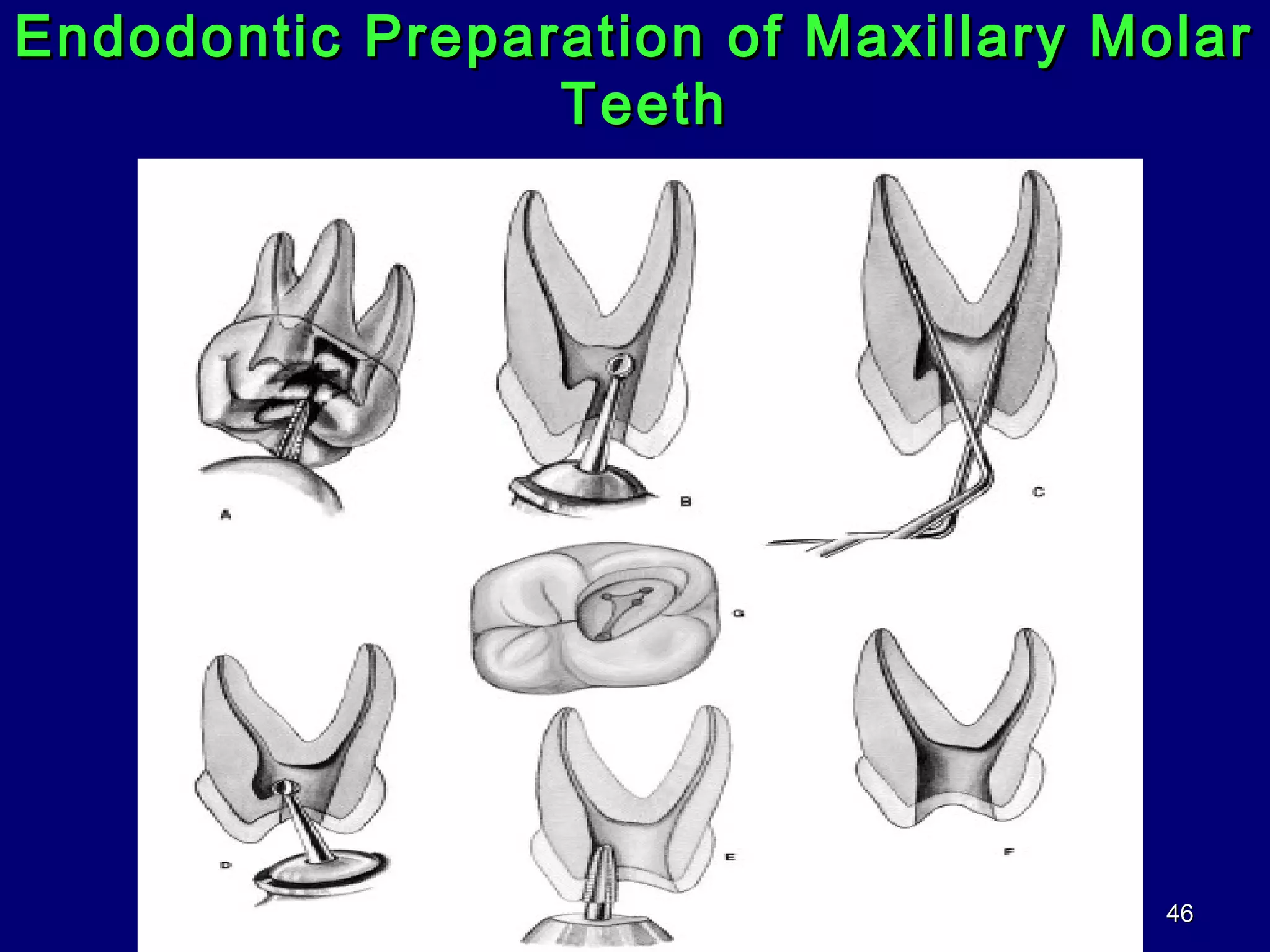 012 access cavity preparation PPT Dental Health Diseases and