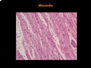 Miocardio
 