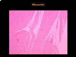 Miocardio
 