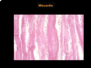 Miocardio
 