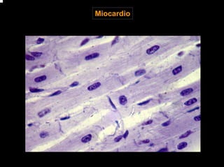Miocardio
 