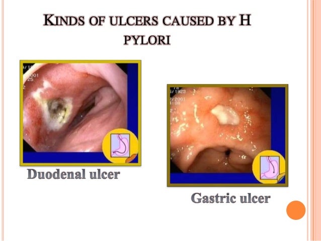 H Pylori Vs Campilobacter Jenuni