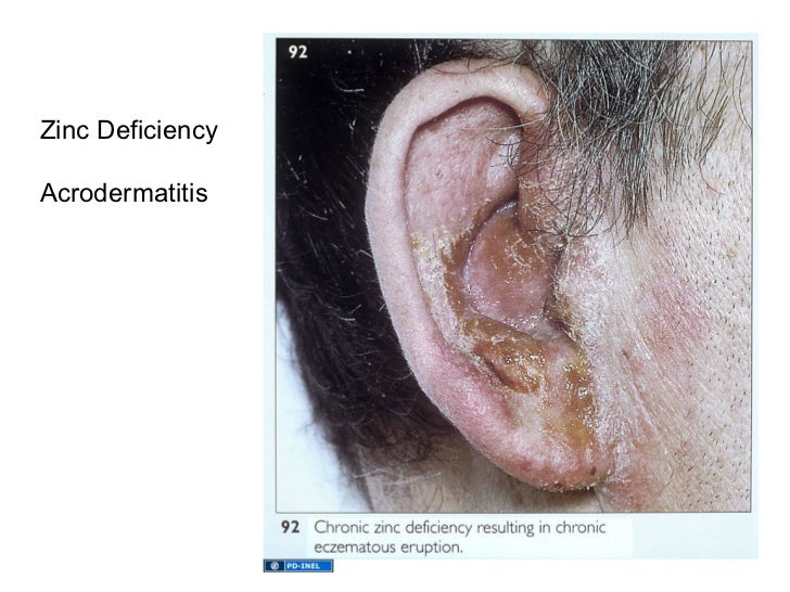 01.27.12 Malabsorption of Nutrients