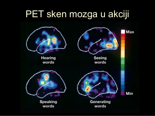PET sken mozga u akcijiPET sken mozga u akciji
 
