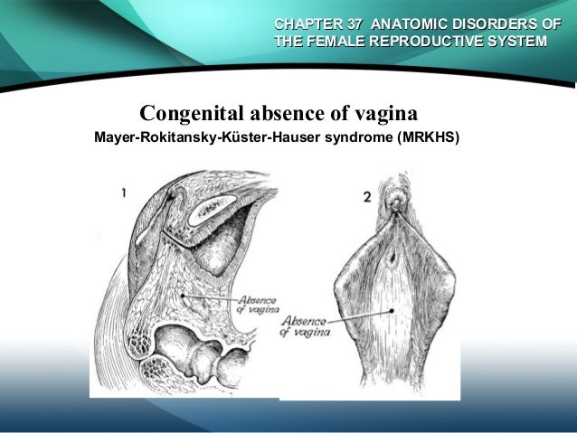 Congenital absence of vagina photos and other amusements