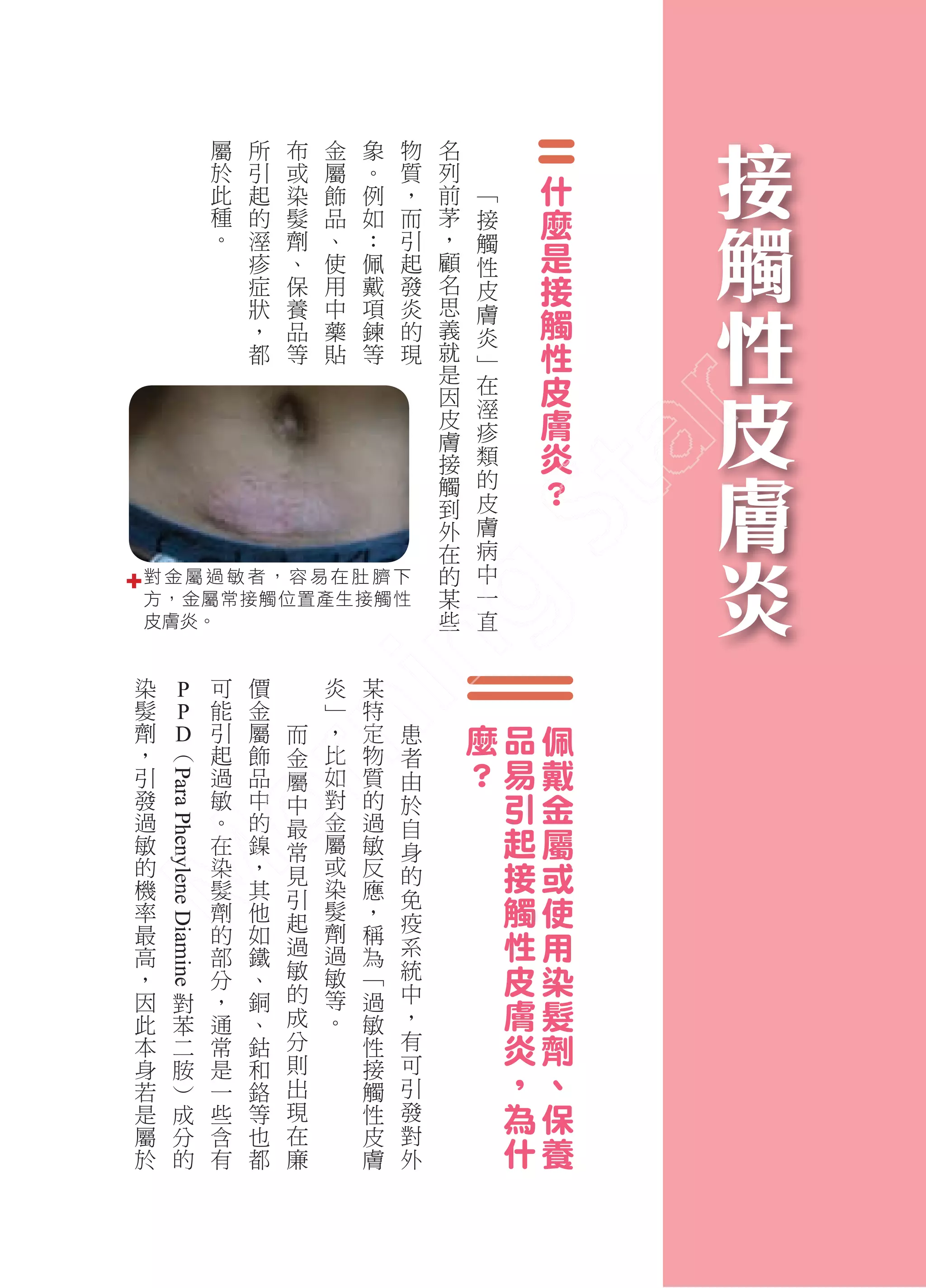 屬       所       布       金       象       物   名                       接
                                                                                                     觸
                                 於       引       或       屬       。       質   列
                                 此       起       染       飾       例       ，   前       ﹁       什
                                 種       的       髮       品       如       而   茅       接       麼
                                 。       溼       劑       、       ：       引   ，


                                                                                                     性
                                         疹       、       使       佩       起   顧
                                                                                     觸
                                                                                     性
                                                                                             是
                                         症       保       用       戴       發   名       皮       接
                                         狀       養       中       項       炎   思       膚       觸

                                                                                                     皮
                                         ，       品       藥       鍊       的   義       炎
                                         都       等       貼       等       現   就       ﹂       性
                                                                             是
                                                                             因
                                                                                     在       皮

                                                                                                     膚
                                                                             皮       溼       膚
                                                                             膚       疹
                                                                             接       類       炎
                                                                             觸       的       ？

                                                                                                     炎
                                                                             到       皮
                                                                             外       膚
                                                                             在       病
                                                                             的       中
對金屬過敏者，容易在肚臍下                                                                某       一
方，金屬常接觸位置產生接觸性                                                               些       直
皮膚炎。

染                            可       價               炎       某
髮       P                    能       金               ﹂       特
劑       P                    引       屬       而       ，       定       患           麼       品       佩
，       D
        ︵                    起       飾       金       比       物       者
引                            過       品       屬       如       質       由
                                                                                 ？       易       戴
                                                                                         引       金
    Para Phenylene Diamine




發                            敏       中       中       對       的       於
過                            。       的               金       過
敏                            在       鎳
                                             最
                                             常       屬       敏
                                                                     自
                                                                     身
                                                                                         起       屬
的                            染       ，       見       或
                                                     染
                                                             反       的                   接       或
機                            髮       其                       應
率                            劑       他
                                             引
                                             起
                                                     髮       ，
                                                                     免
                                                                     疫
                                                                                         觸       使
最
高
                             的
                             部
                                     如
                                     鐵       過
                                                     劑
                                                     過
                                                             稱
                                                             為       系                   性       用
，                            分       、       敏       敏       ﹁       統                   皮       染
                                             的                       中
因
此
               對
               苯
                             ，
                             通
                                     銅
                                     、       成
                                                     等
                                                     。
                                                             過
                                                             敏       ，                   膚       髮
本              二             常       鈷       分               性       有                   炎       劑
                                             則                       可
身
若
               胺
               ︶
                             是
                             一
                                     和
                                     鉻       出
                                                             接
                                                             觸       引                   ，       、
是              成             些       等       現               性       發                   為       保
屬              分             含       也       在               皮       對
於              的             有       都       廉               膚       外
                                                                                         什       養

                                                                                                         32
 