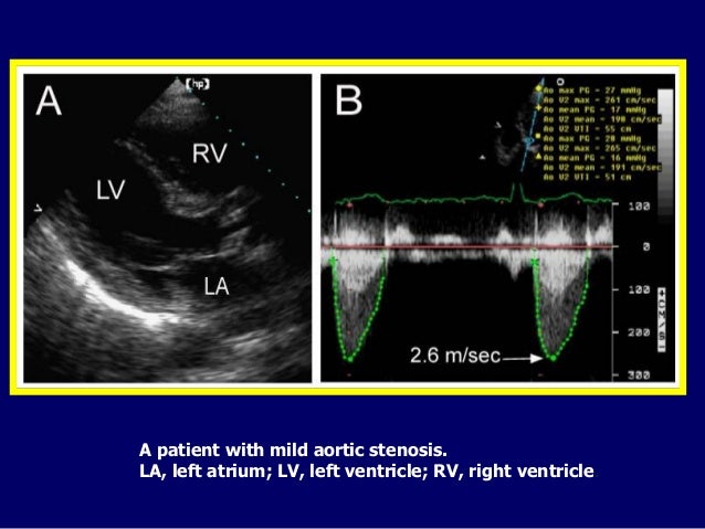 Lev Mendelevich MD — Trans Catheter Treatment of Structural Heart Dis…