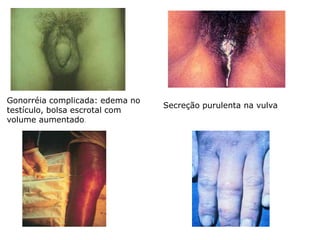 Gonorréia complicada: edema no
                                 Secreção purulenta na vulva
testículo, bolsa escrotal com
volume aumentado.
 