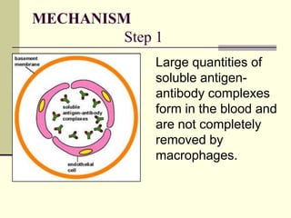 MECHANISM
Step 1
Large quantities of
soluble antigen-
antibody complexes
form in the blood and
are not completely
removed by
macrophages.
 