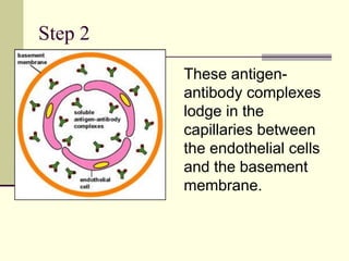 Step 2
These antigen-
antibody complexes
lodge in the
capillaries between
the endothelial cells
and the basement
membrane.
 