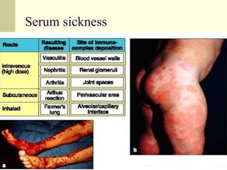Serum sickness
 