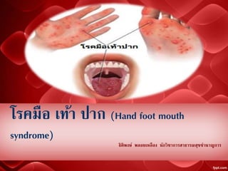 โรคมือ เท้า ปาก (Hand foot mouth
syndrome)
ธิติพงษ์ พลอยเหลือง นักวิชาการสาธารณสุขชานาญการ
 